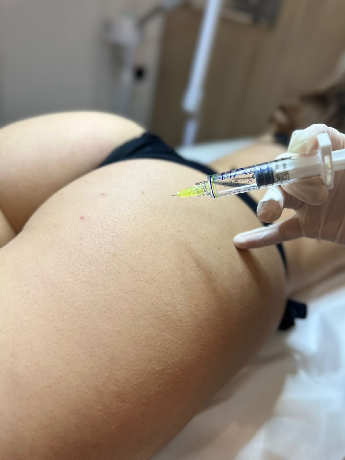 Ενέσιμη Λιποδιάλυση κατά της Κυτταρίτιδας